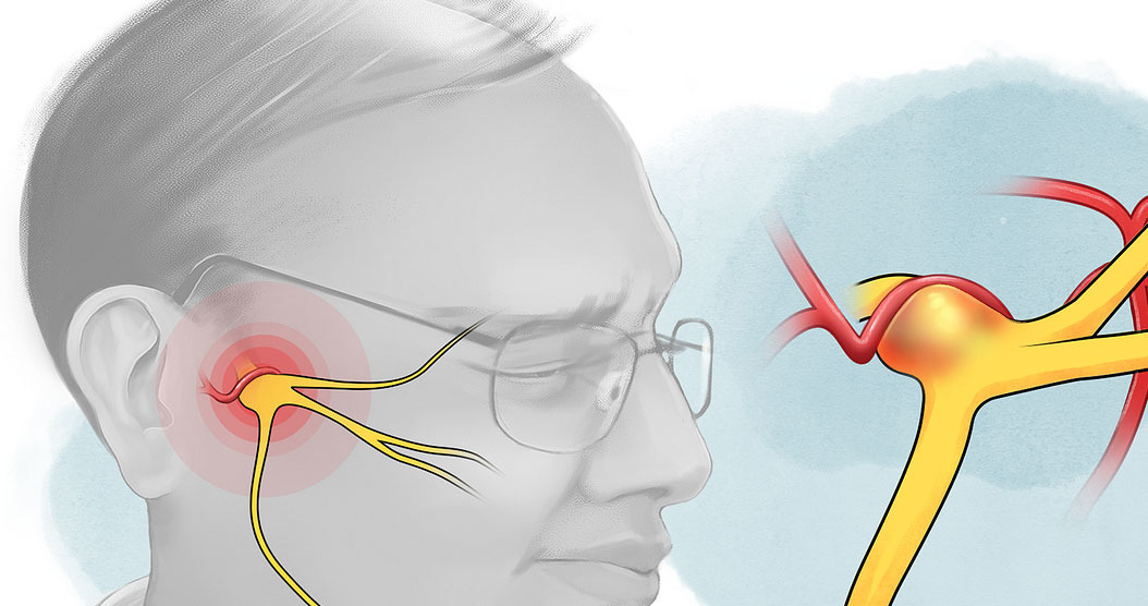 Trigeminal neuralgia – موقع الدكتور عمر حبش